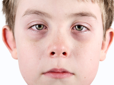 schatten unter den augen bei kindern